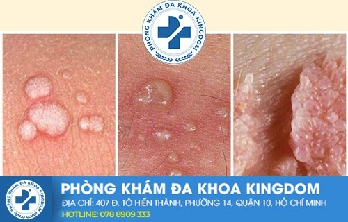 Dấu hiệu sùi mào gà cần lưu ý